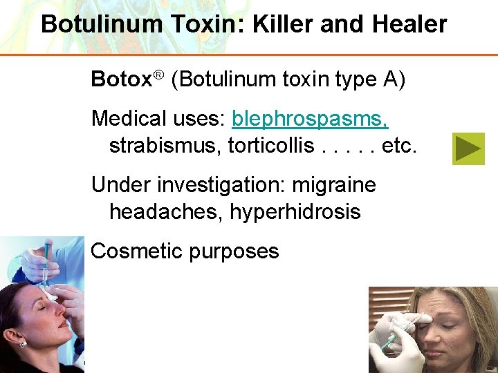 Botulinum Toxin: Killer and Healer Botox (Botulinum toxin type A) Medical uses: blephrospasms, strabismus,