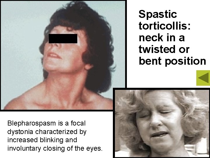 Spastic torticollis: neck in a twisted or bent position Blepharospasm is a focal dystonia