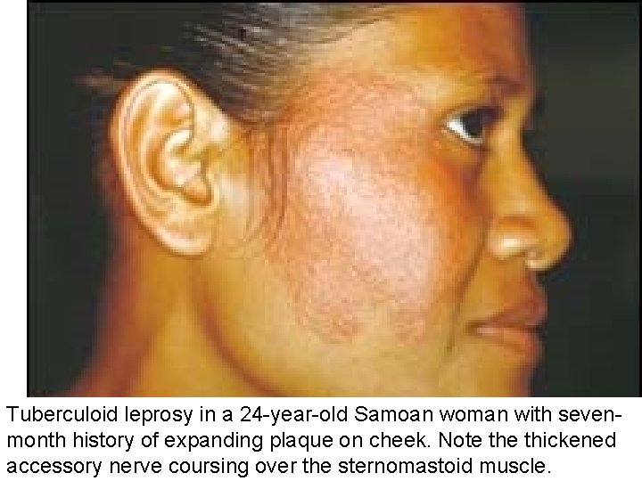 Tuberculoid leprosy in a 24 -year-old Samoan woman with sevenmonth history of expanding plaque
