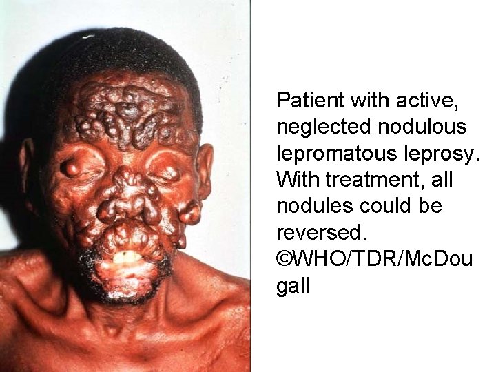 Patient with active, neglected nodulous lepromatous leprosy. With treatment, all nodules could be reversed.
