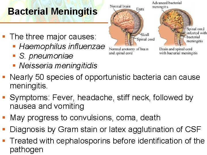 Bacterial Meningitis § The three major causes: § Haemophilus influenzae § S. pneumoniae §