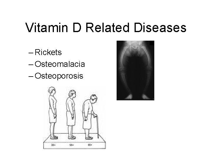 Vitamin D Related Diseases – Rickets – Osteomalacia – Osteoporosis 