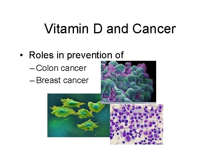 Vitamin D and Cancer • Roles in prevention of – Colon cancer – Breast