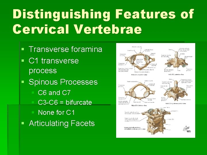 Distinguishing Features of Cervical Vertebrae § Transverse foramina § C 1 transverse process §