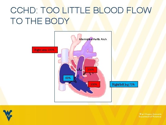 CCHD: TOO LITTLE BLOOD FLOW TO THE BODY Interrupted Aortic Arch Right arm 100%