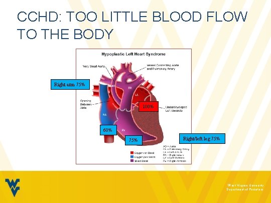 CCHD: TOO LITTLE BLOOD FLOW TO THE BODY Right arm 75% 100% 60% 75%