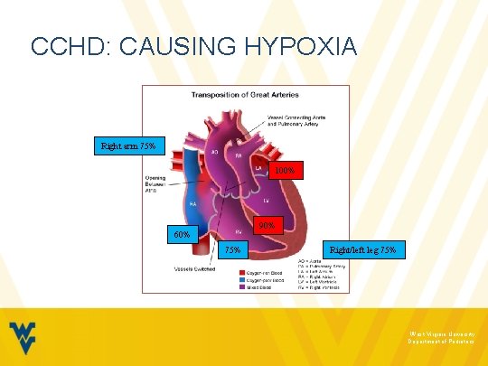 CCHD: CAUSING HYPOXIA Right arm 75% 100% 90% 60% 75% Right/left leg 75% West