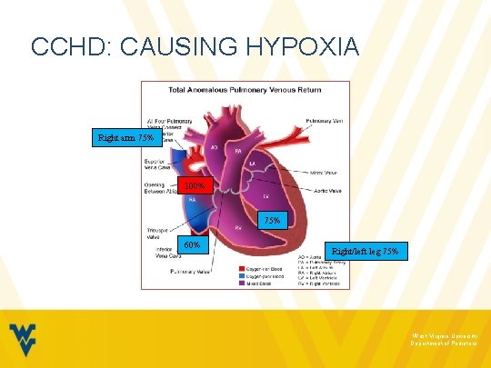 CCHD: CAUSING HYPOXIA Right arm 75% 100% 75% 60% Right/left leg 75% West Virginia