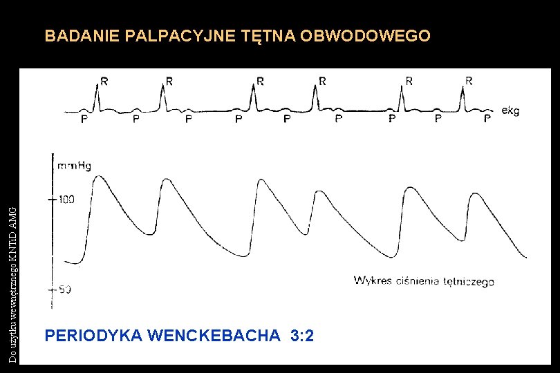 Do użytku wewnętrznego KNTi. D AMG BADANIE PALPACYJNE TĘTNA OBWODOWEGO PERIODYKA WENCKEBACHA 3: 2