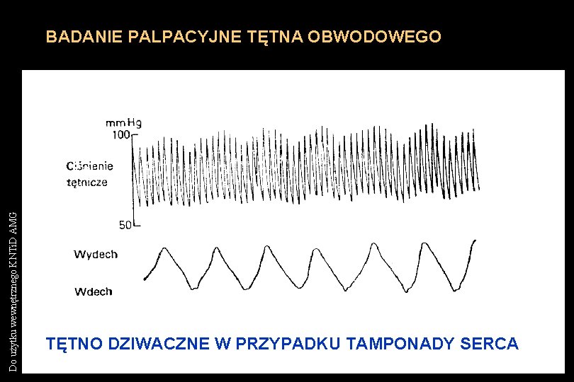 Do użytku wewnętrznego KNTi. D AMG BADANIE PALPACYJNE TĘTNA OBWODOWEGO TĘTNO DZIWACZNE W PRZYPADKU