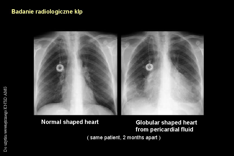 Do użytku wewnętrznego KNTi. D AMG Badanie radiologiczne klp Normal shaped heart Globular shaped