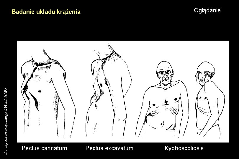 Oglądanie Do użytku wewnętrznego KNTi. D AMG Badanie układu krążenia Pectus carinatum Pectus excavatum