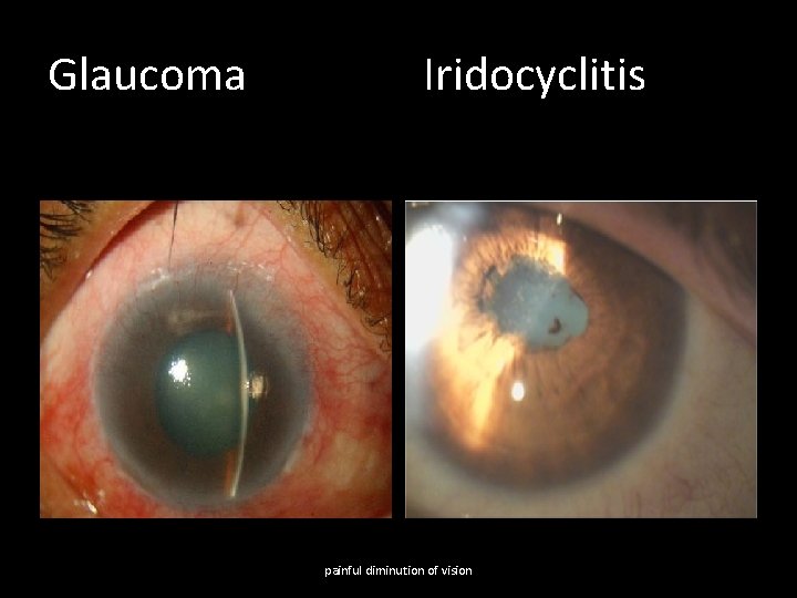 Glaucoma Iridocyclitis painful diminution of vision 