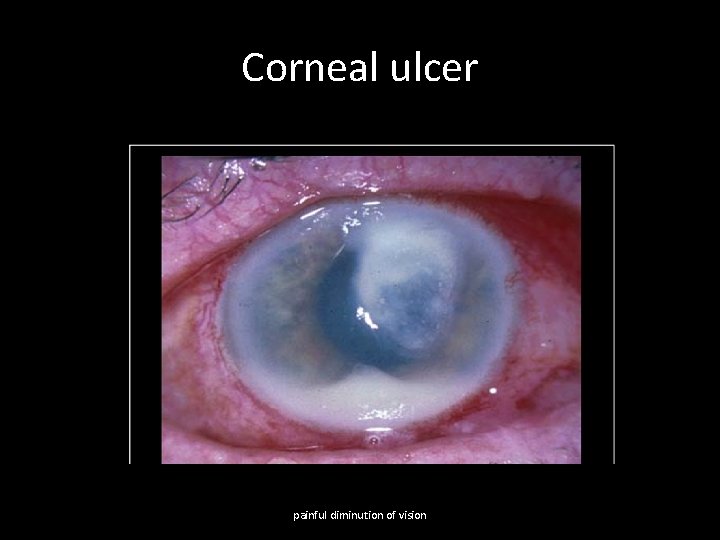 Corneal ulcer painful diminution of vision 