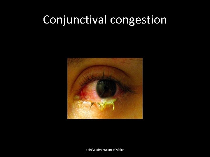 Conjunctival congestion painful diminution of vision 