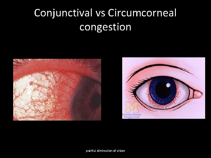 Conjunctival vs Circumcorneal congestion painful diminution of vision 