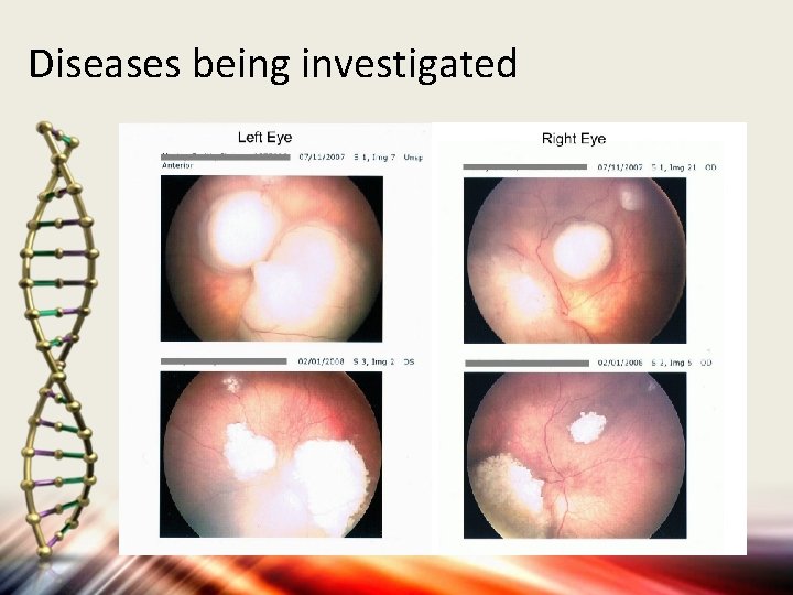 Diseases being investigated • Eye diseases – Retinoblastoma • • primary intraocular tumor of