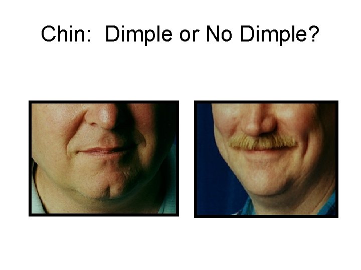 Chin: Dimple or No Dimple? 