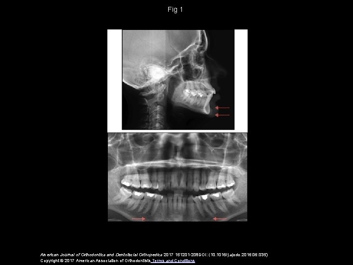 Fig 1 American Journal of Orthodontics and Dentofacial Orthopedics 2017 151201 -208 DOI: (10.