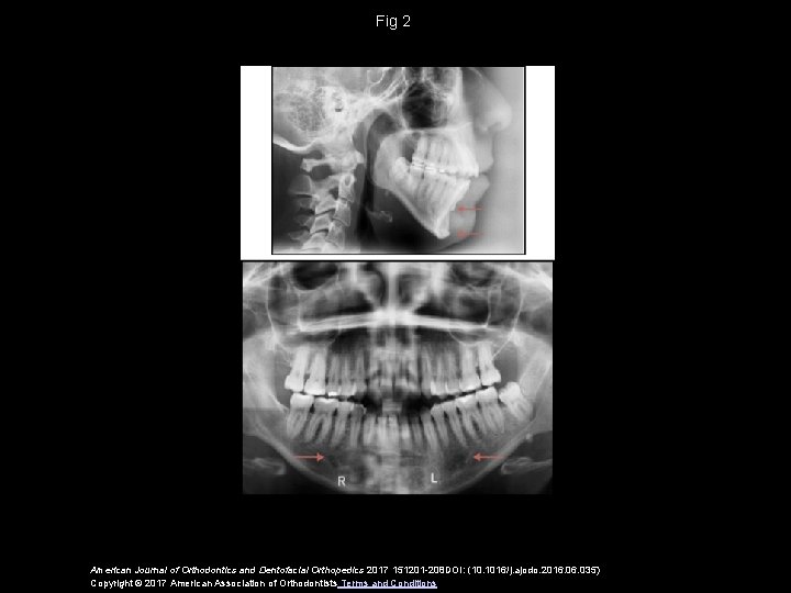 Fig 2 American Journal of Orthodontics and Dentofacial Orthopedics 2017 151201 -208 DOI: (10.