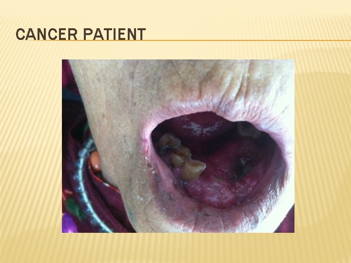 CANCER PATIENT 