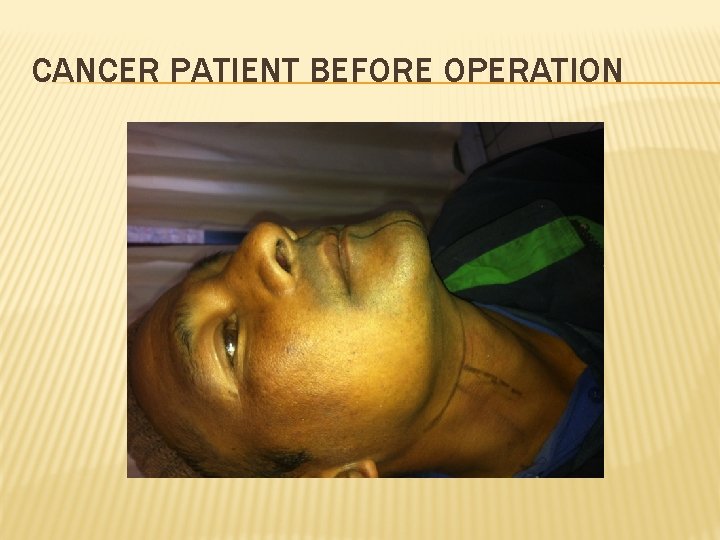 CANCER PATIENT BEFORE OPERATION 