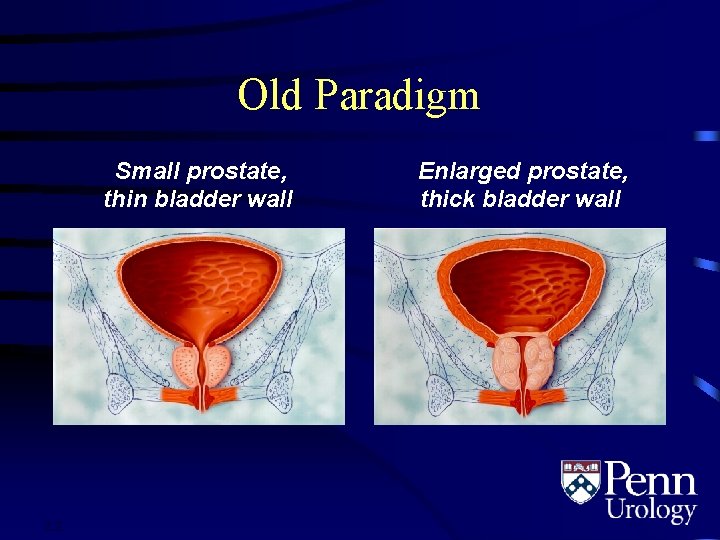 Old Paradigm Small prostate, thin bladder wall 2. 2 Enlarged prostate, thick bladder wall
