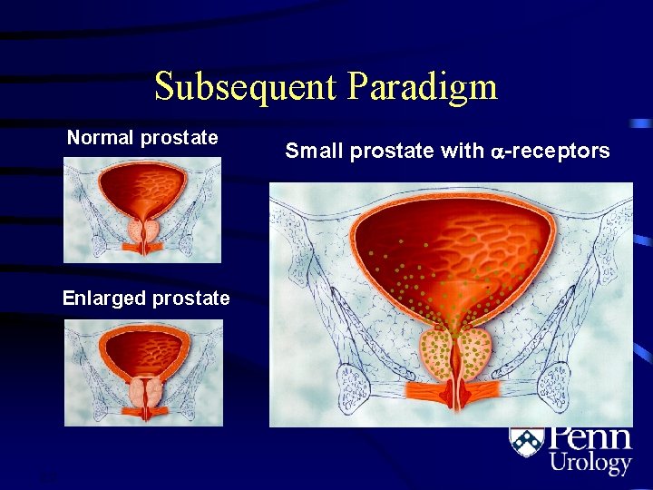 Subsequent Paradigm Normal prostate Enlarged prostate 2. 3 Small prostate with -receptors 