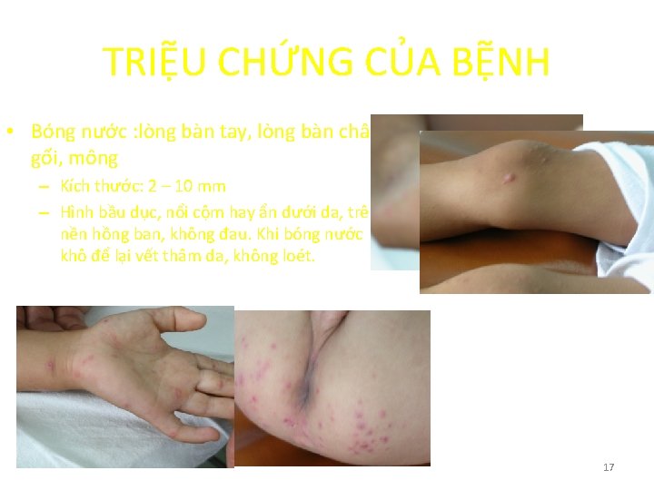 TRIỆU CHỨNG CỦA BỆNH • Bóng nước : lòng bàn tay, lòng bàn chân,