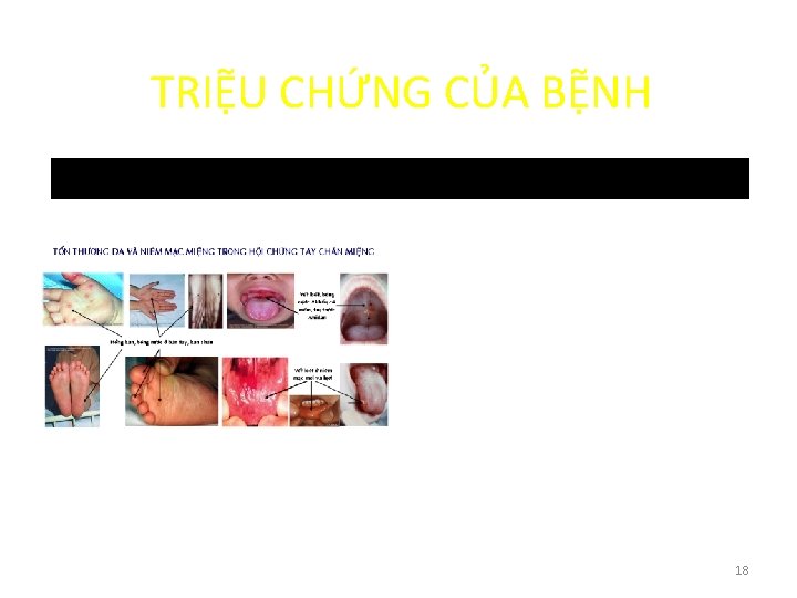 TRIỆU CHỨNG CỦA BỆNH 18 