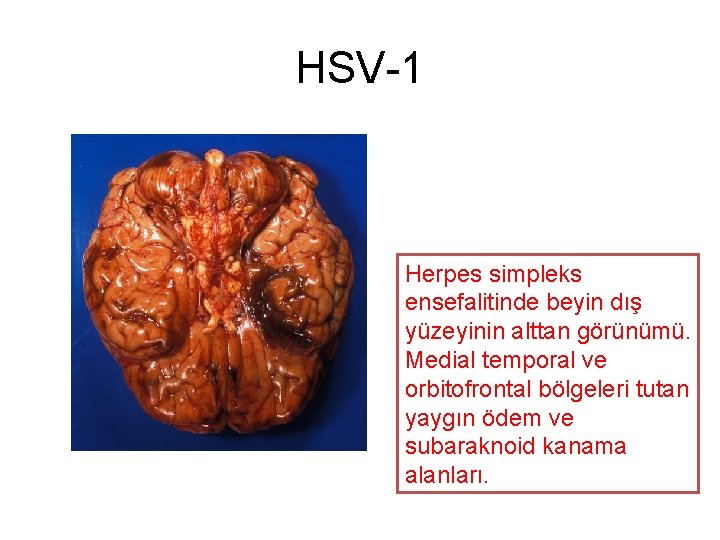 HSV-1 Herpes simpleks ensefalitinde beyin dış yüzeyinin alttan görünümü. Medial temporal ve orbitofrontal bölgeleri