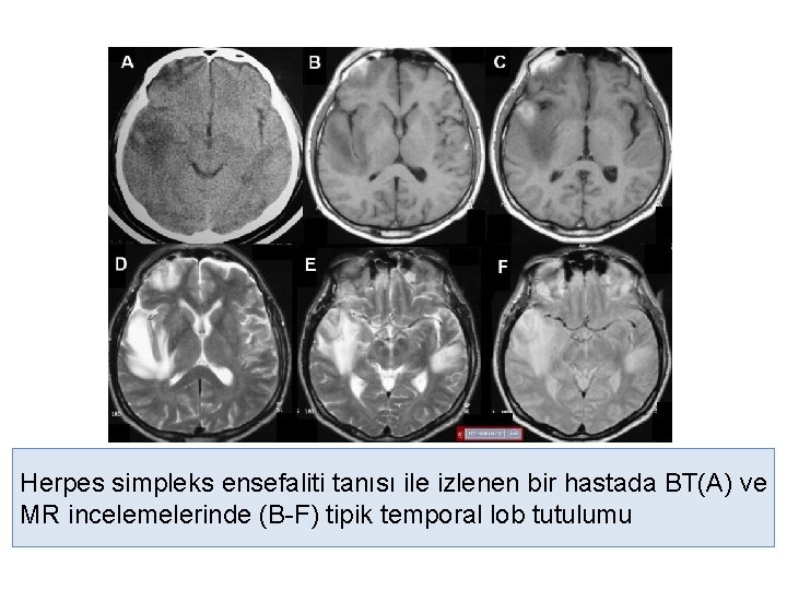 Herpes simpleks ensefaliti tanısı ile izlenen bir hastada BT(A) ve MR incelemelerinde (B-F) tipik