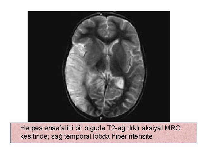 Herpes ensefalitli bir olguda T 2 -ağırlıklı aksiyal MRG kesitinde; sağ temporal lobda hiperintensite