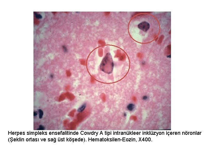 Herpes simpleks ensefalitinde Cowdry A tipi intranükleer inklüzyon içeren nöronlar (Şeklin ortası ve sağ