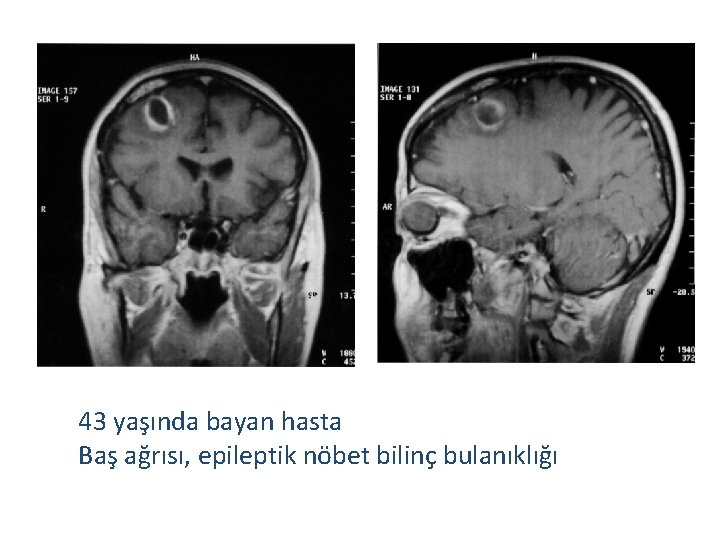 43 yaşında bayan hasta Baş ağrısı, epileptik nöbet bilinç bulanıklığı 