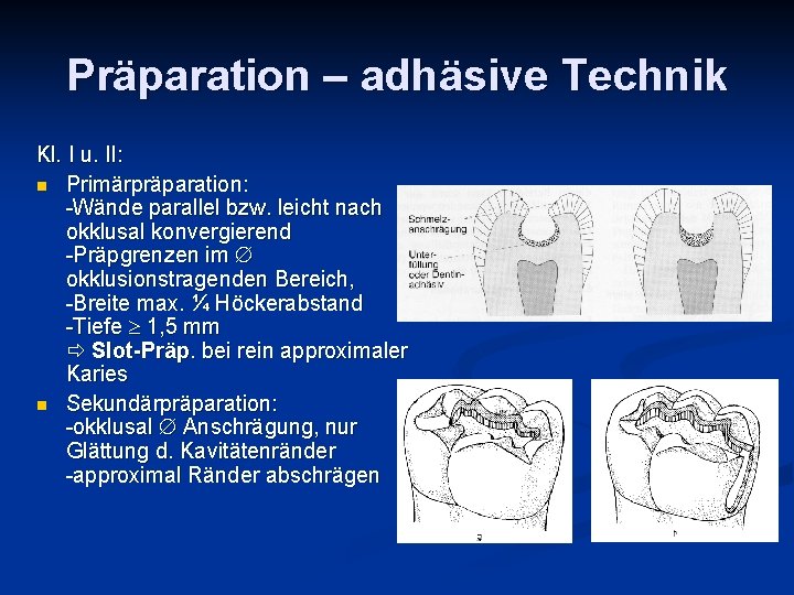 Präparation – adhäsive Technik Kl. I u. II: n Primärpräparation: -Wände parallel bzw. leicht