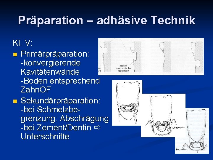 Präparation – adhäsive Technik Kl. V: n Primärpräparation: -konvergierende Kavitätenwände -Boden entsprechend Zahn. OF