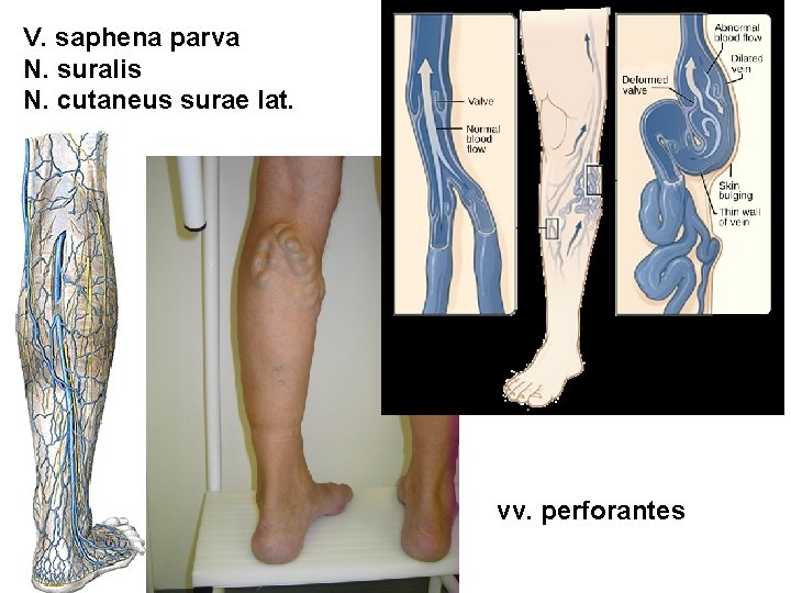 V. saphena parva N. suralis N. cutaneus surae lat. vv. perforantes 