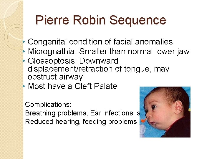 Pierre Robin Sequence • Congenital condition of facial anomalies • Micrognathia: Smaller than normal