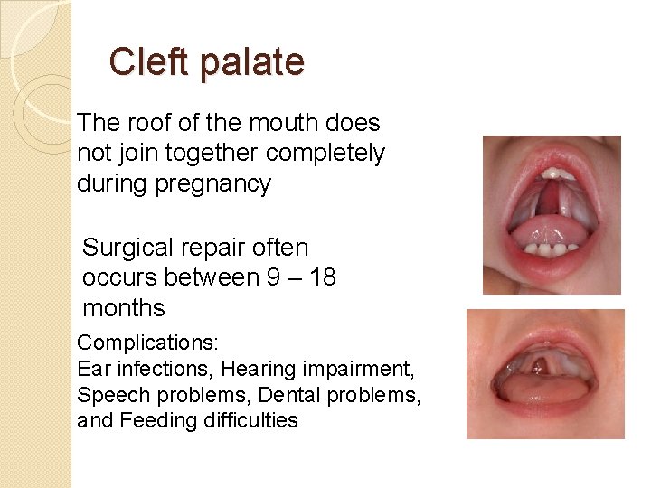Cleft palate The roof of the mouth does not join together completely during pregnancy