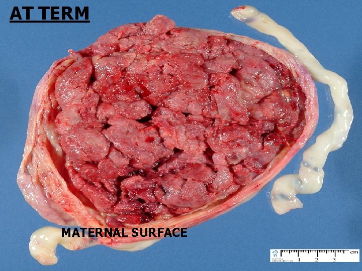 AT TERM MATERNAL SURFACE 