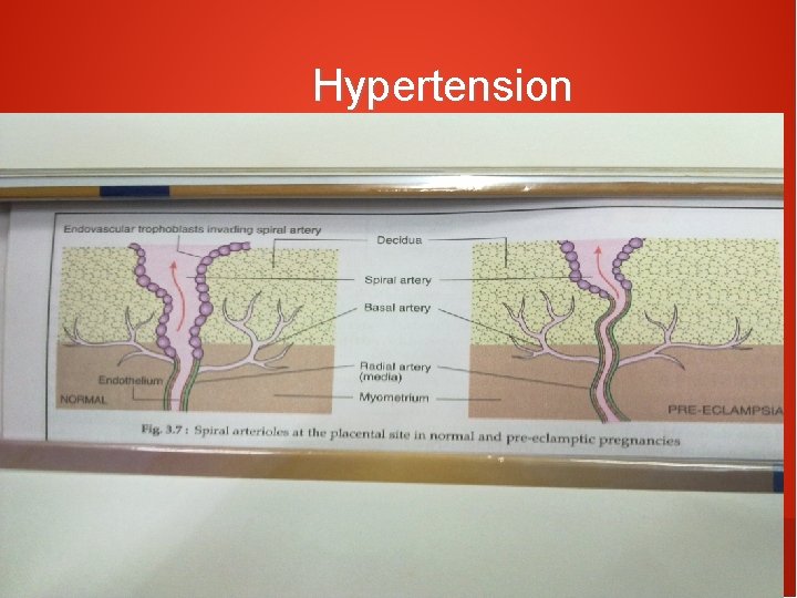 Hypertension 