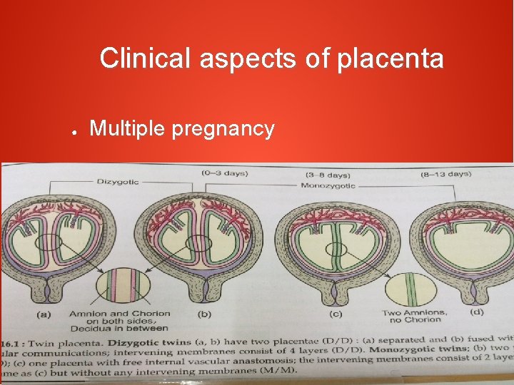 Clinical aspects of placenta ● Multiple pregnancy 