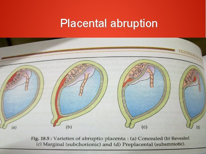 Placental abruption 