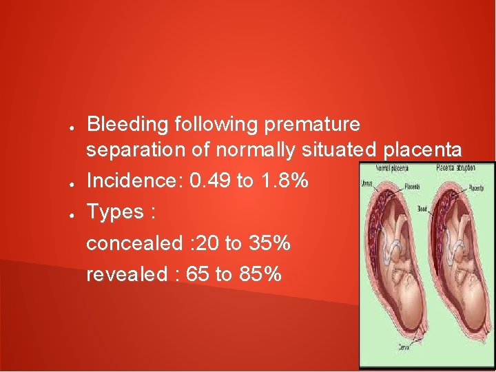 ● ● ● Bleeding following premature separation of normally situated placenta Incidence: 0. 49