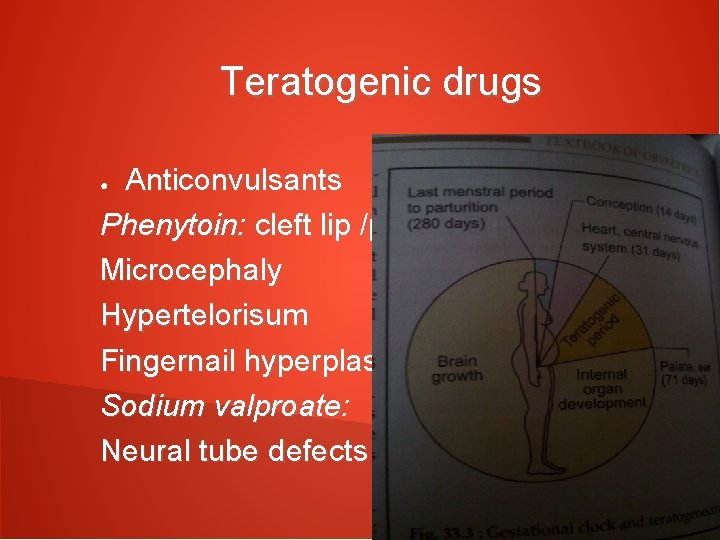 Teratogenic drugs Anticonvulsants Phenytoin: cleft lip /palate Microcephaly Hypertelorisum Fingernail hyperplasia Sodium valproate: Neural