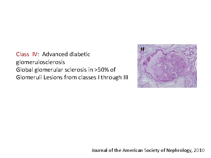 Class IV: Advanced diabetic glomerulosclerosis Global glomerular sclerosis in ˃50% of Glomeruli Lesions from