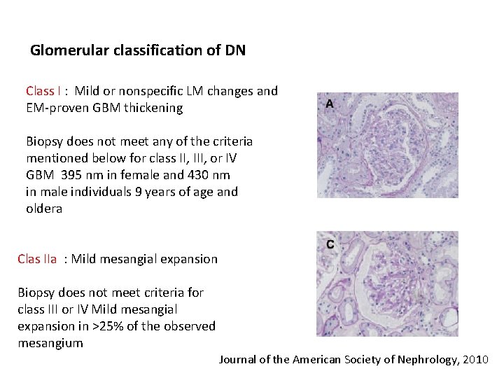 Glomerular classification of DN Class I : Mild or nonspecific LM changes and EM-proven