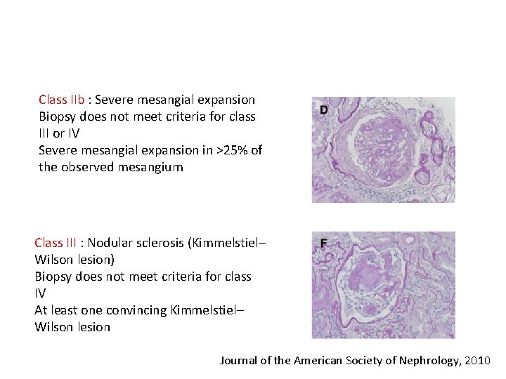 Class IIb : Severe mesangial expansion Biopsy does not meet criteria for class III