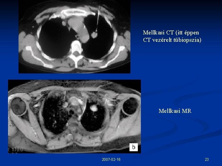 Mellkasi CT (itt éppen CT vezérelt tűbiopszia) Mellkasi MR 2007 -02 -16 23 